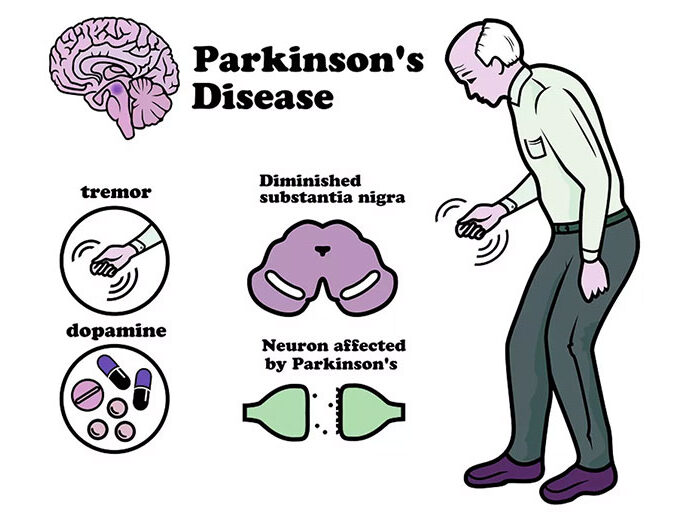 Parkinson's disease