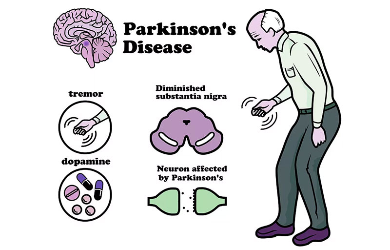 Parkinson's disease