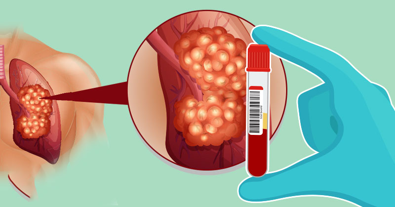 A type of biopsy to test for cancer