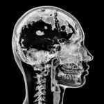 Missives from aneurosurgeon:What a big brain you've got