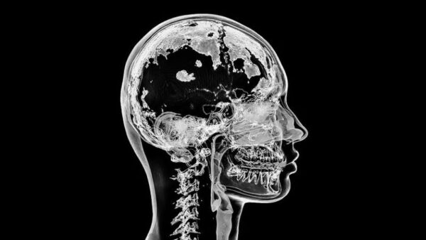 Missives from aneurosurgeon：What a big brain you've got